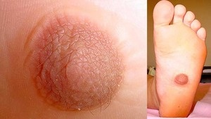 Illustration for article titled Woman Grows Full Size Nipple On Foot